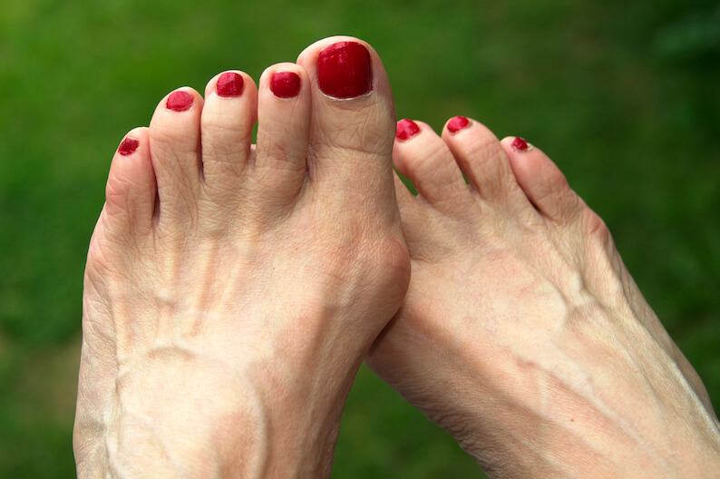 What are Bunions, and How To Treat At Home?