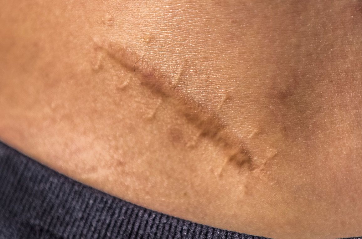 Basal cell carcinomas can appear as pearly bumps or nodules