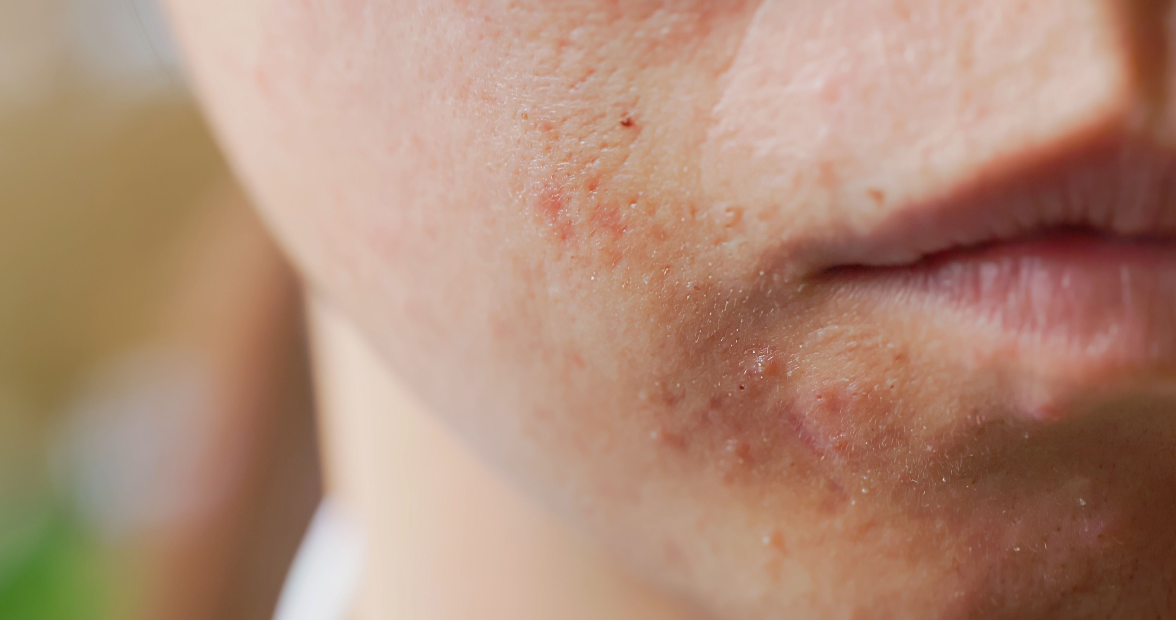 Not all pimples are created equal