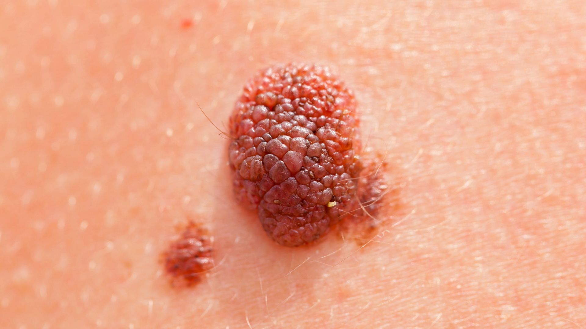 Melanoma can be nodular and thick