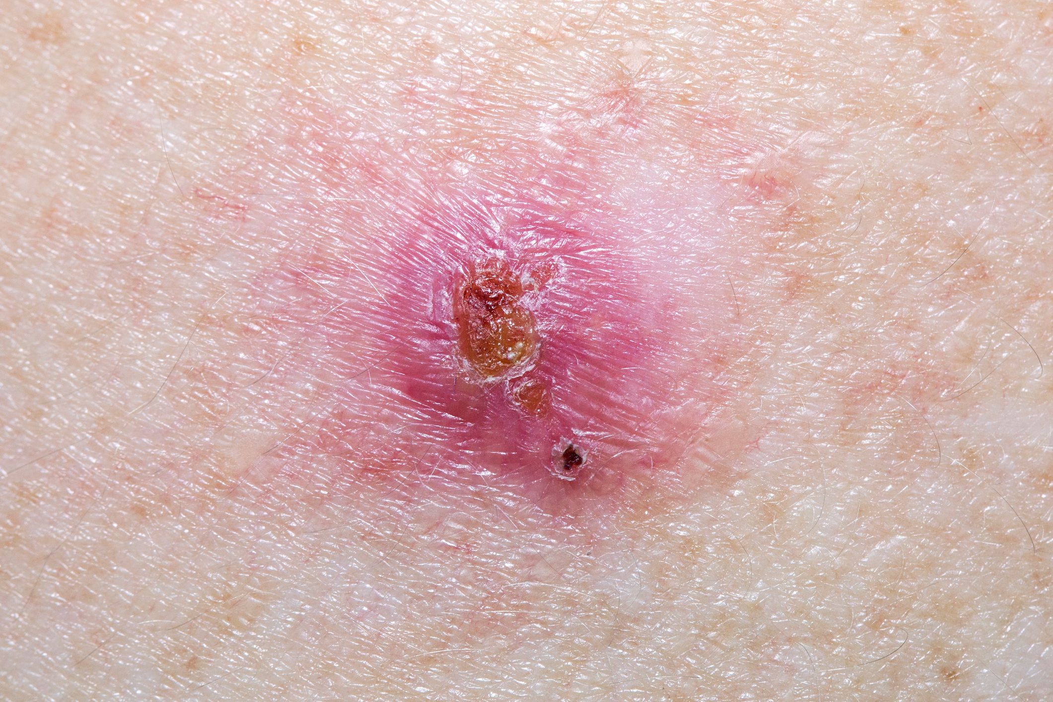 Basal cell carcinomas may be nodular and shiny
