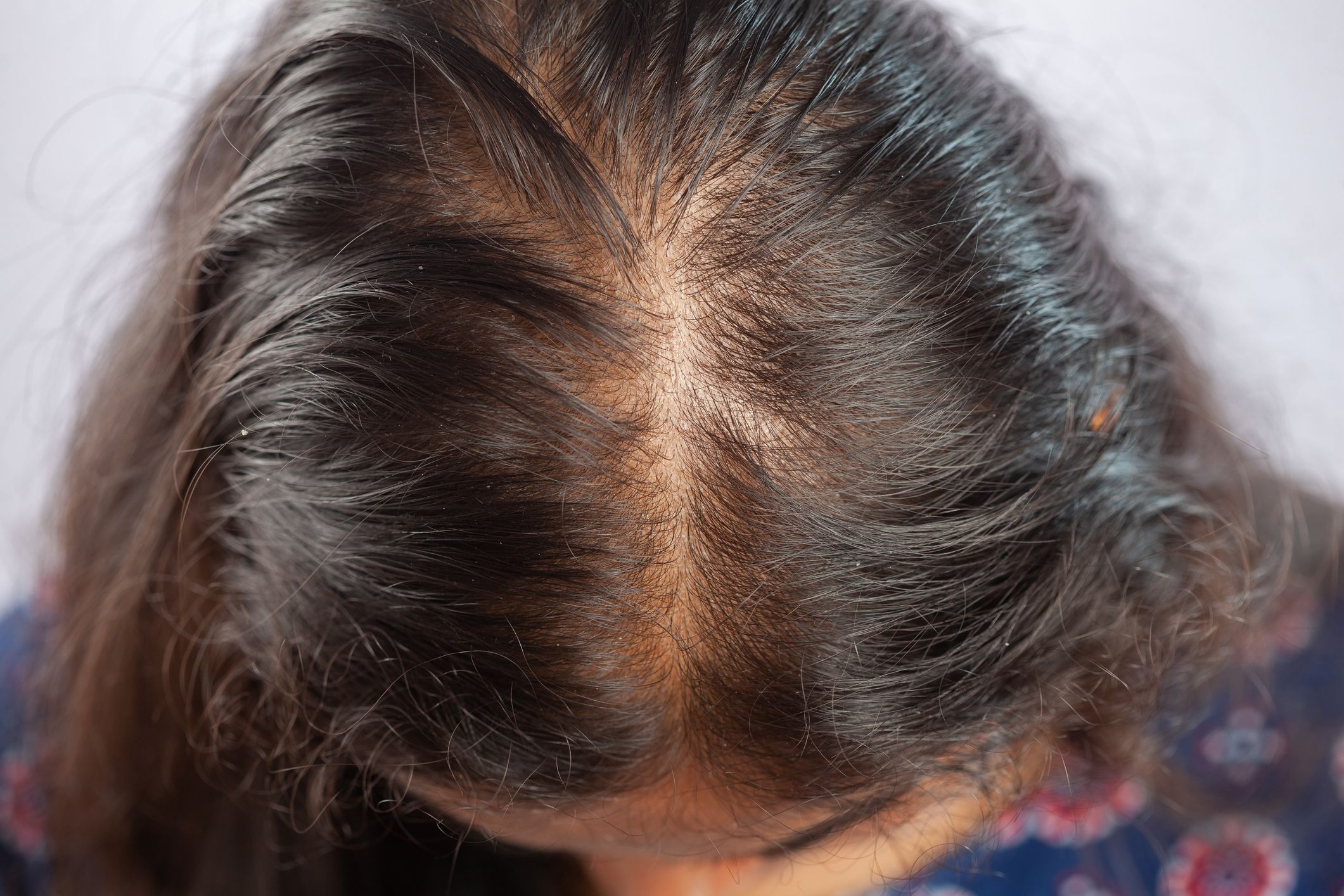 Hair disorders