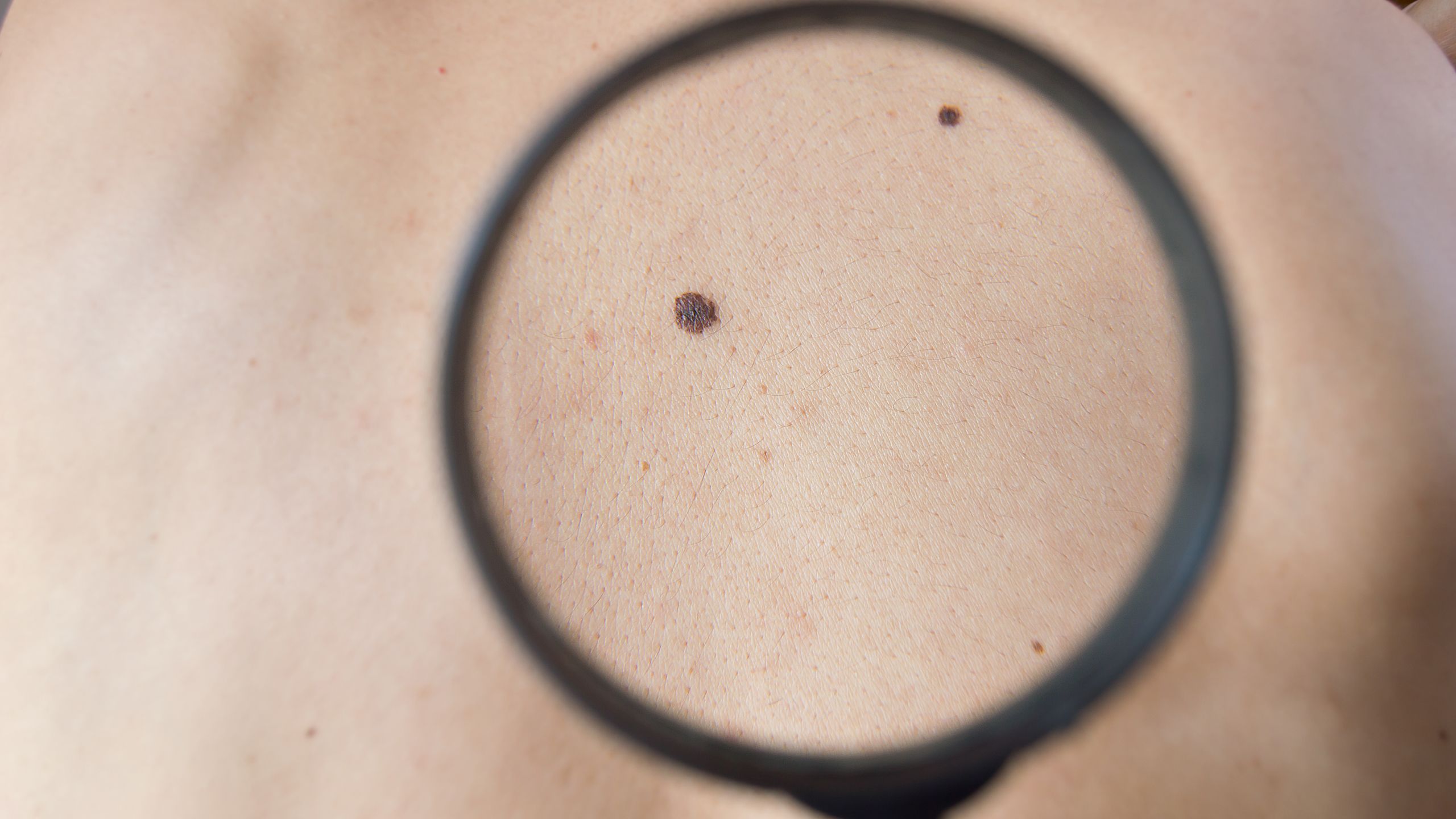 Common moles