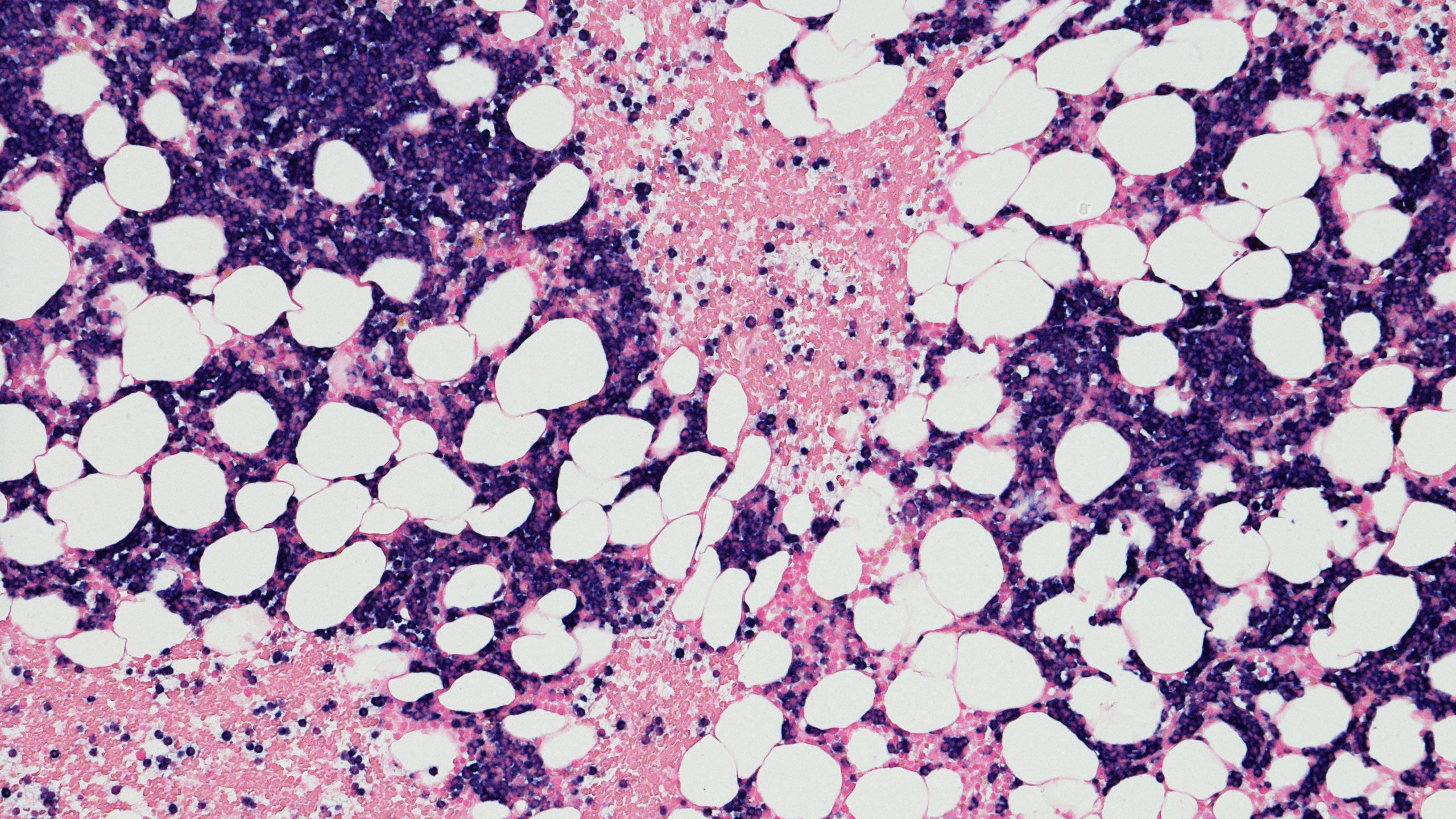 Tumors