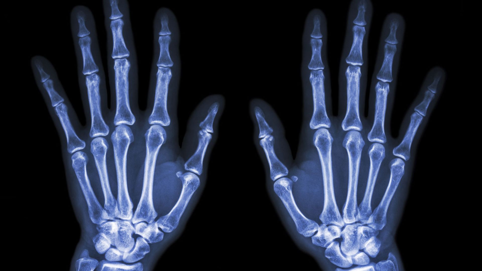 Bone loss