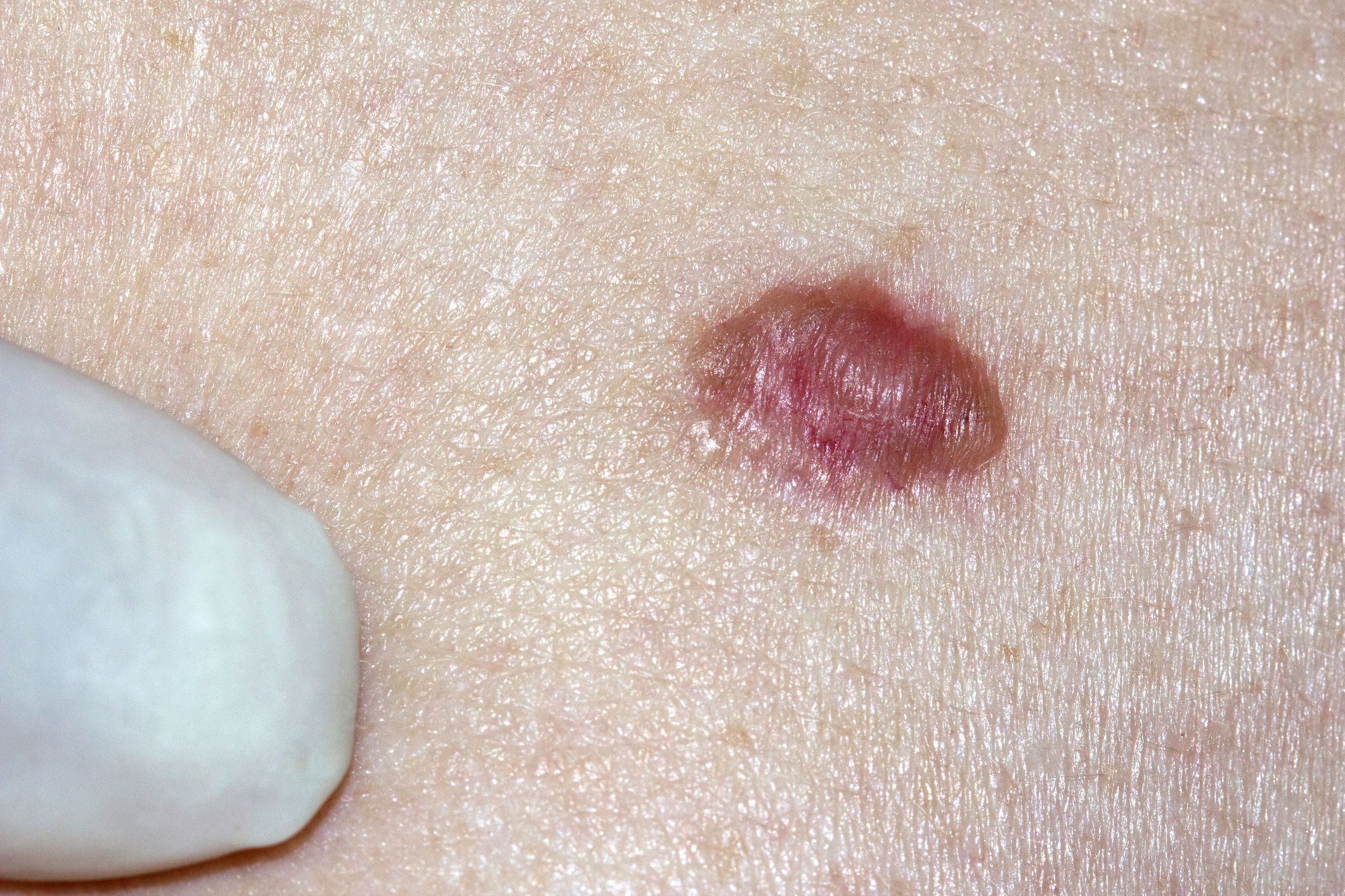 Basal cell carcinomas may be raised growths