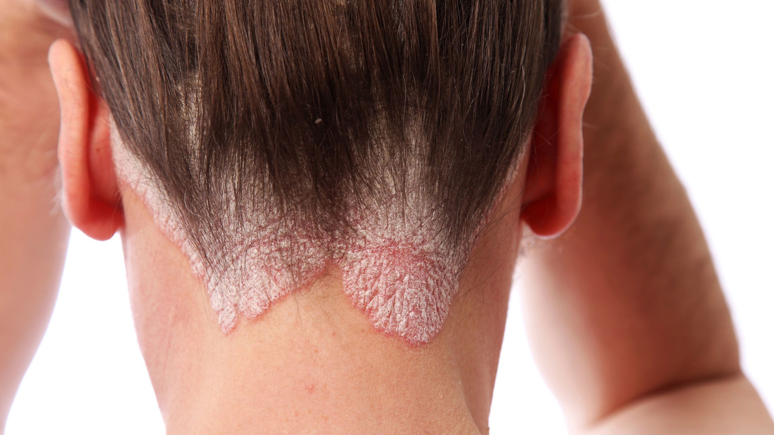 Psoriasis