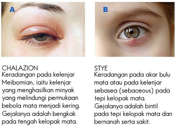 Cara Nak Ubat Mata Ketumbit - Hol Spa