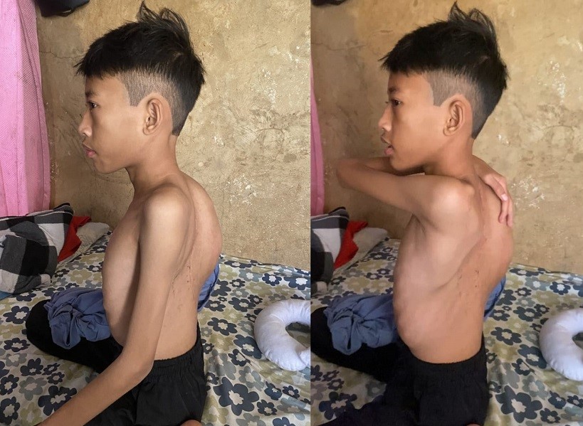 14 Tahun. Falah Hidup Dengan Tulang Bengkok