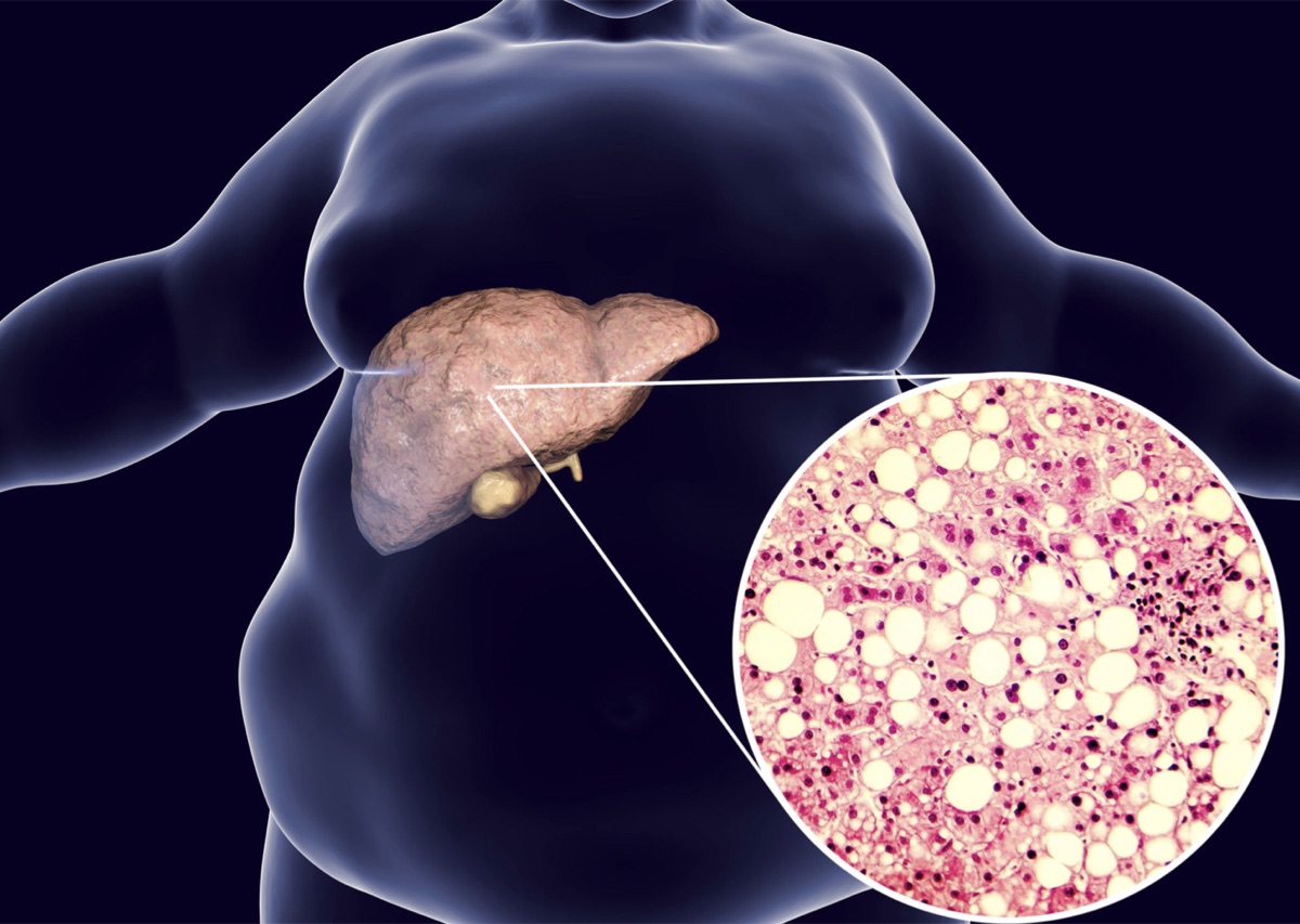 Penyebab Fatty Liver yang Sebenarnya, Bukan Hanya Lemak