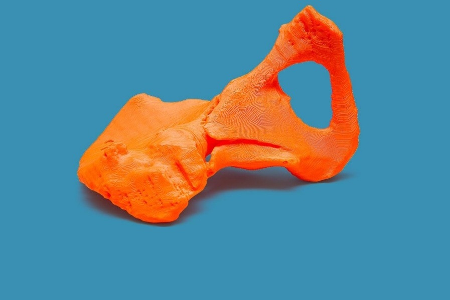 3D anatomical model of broken hemipelvis