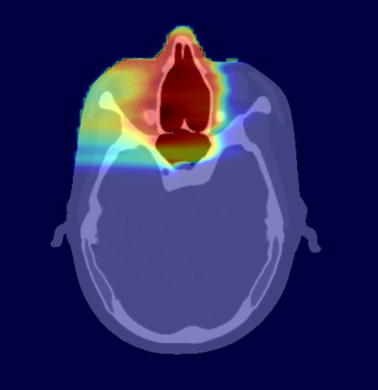 Particle therapy TissueXplorer treatment plan