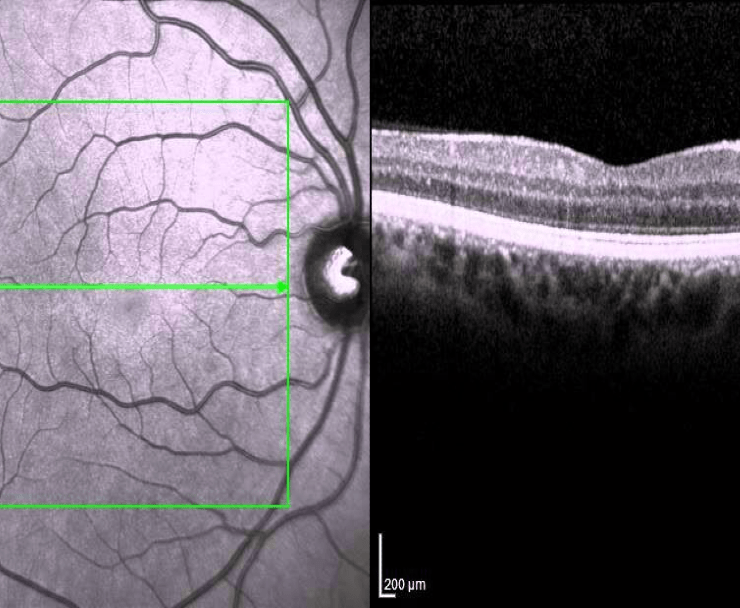 O.C.T Imaging