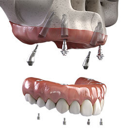 Implant Supported Dentures