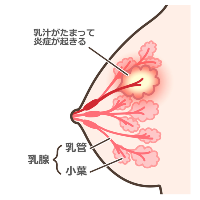 乳管のつまりと乳腺炎