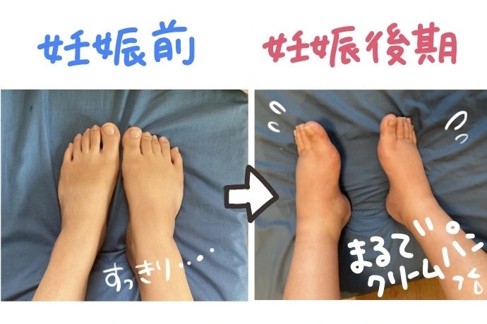 妊娠後期の足のむくみ具合（妊娠前と比較）