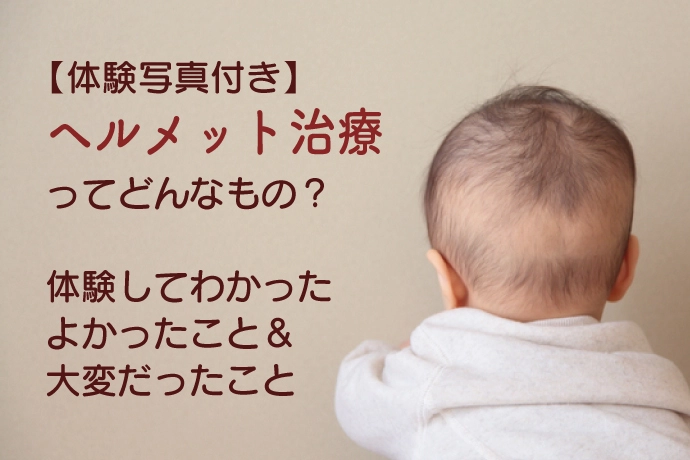 我が家のヘルメット治療の体験談 頭のゆがみってどんなもの 治療の費用は 効果はあるの