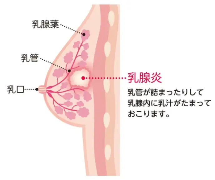 助産師監修 これって乳腺炎なりかけ 乳腺炎の症状別 対処法