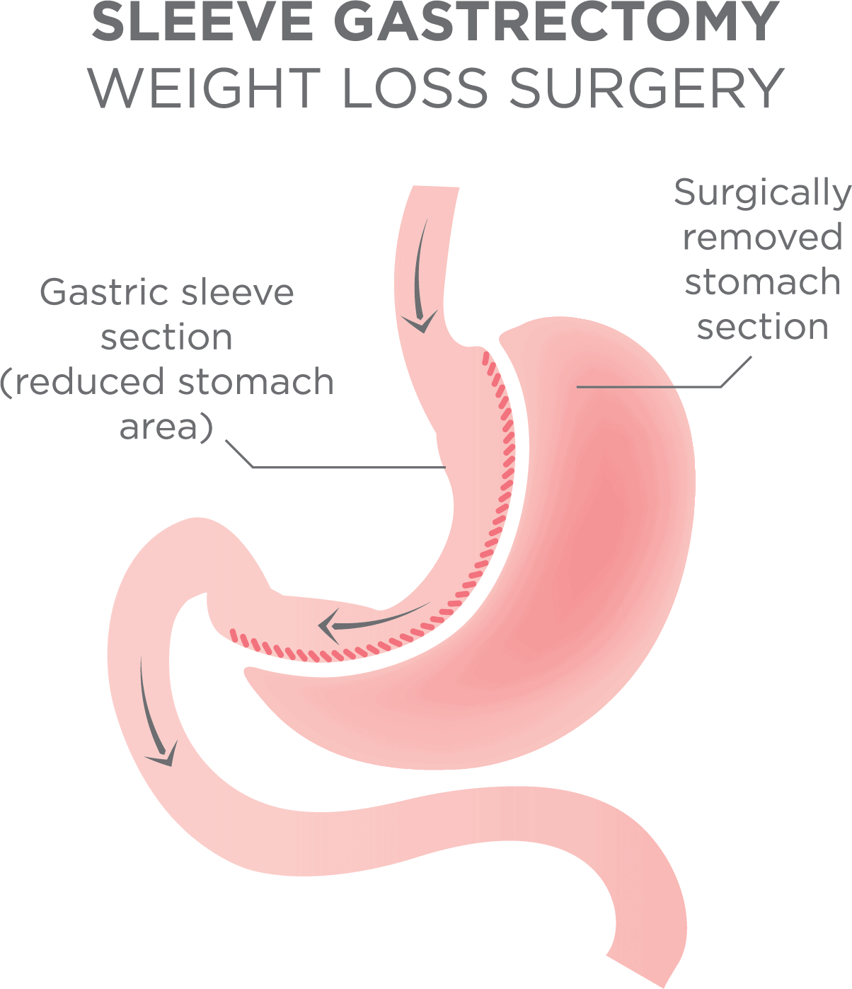 Bariatric Sleeve Vitamins