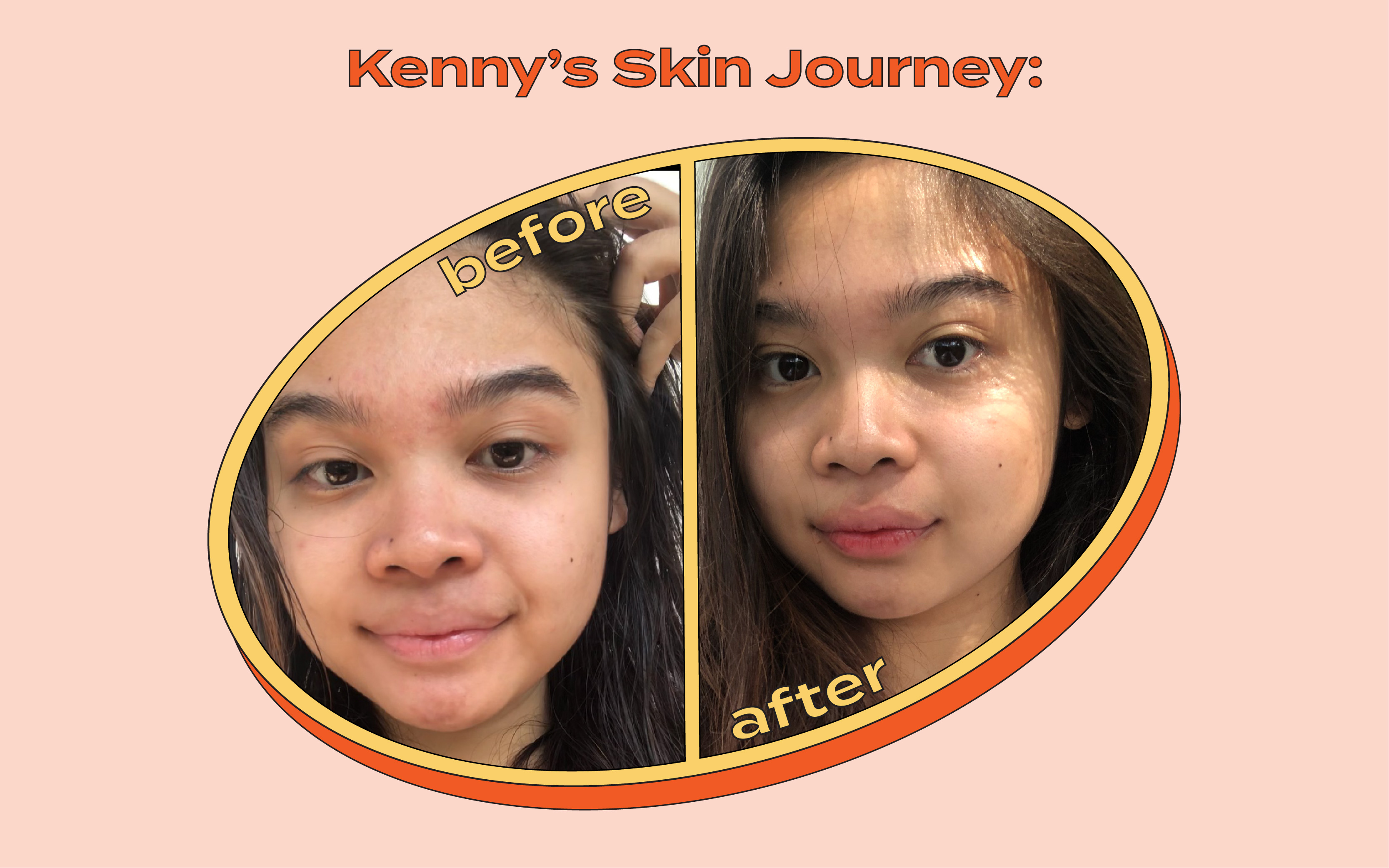 Kenny’s Skin Journey: Tips Mengatasi Bekas Jerawat Untuk Kulit Sensitif