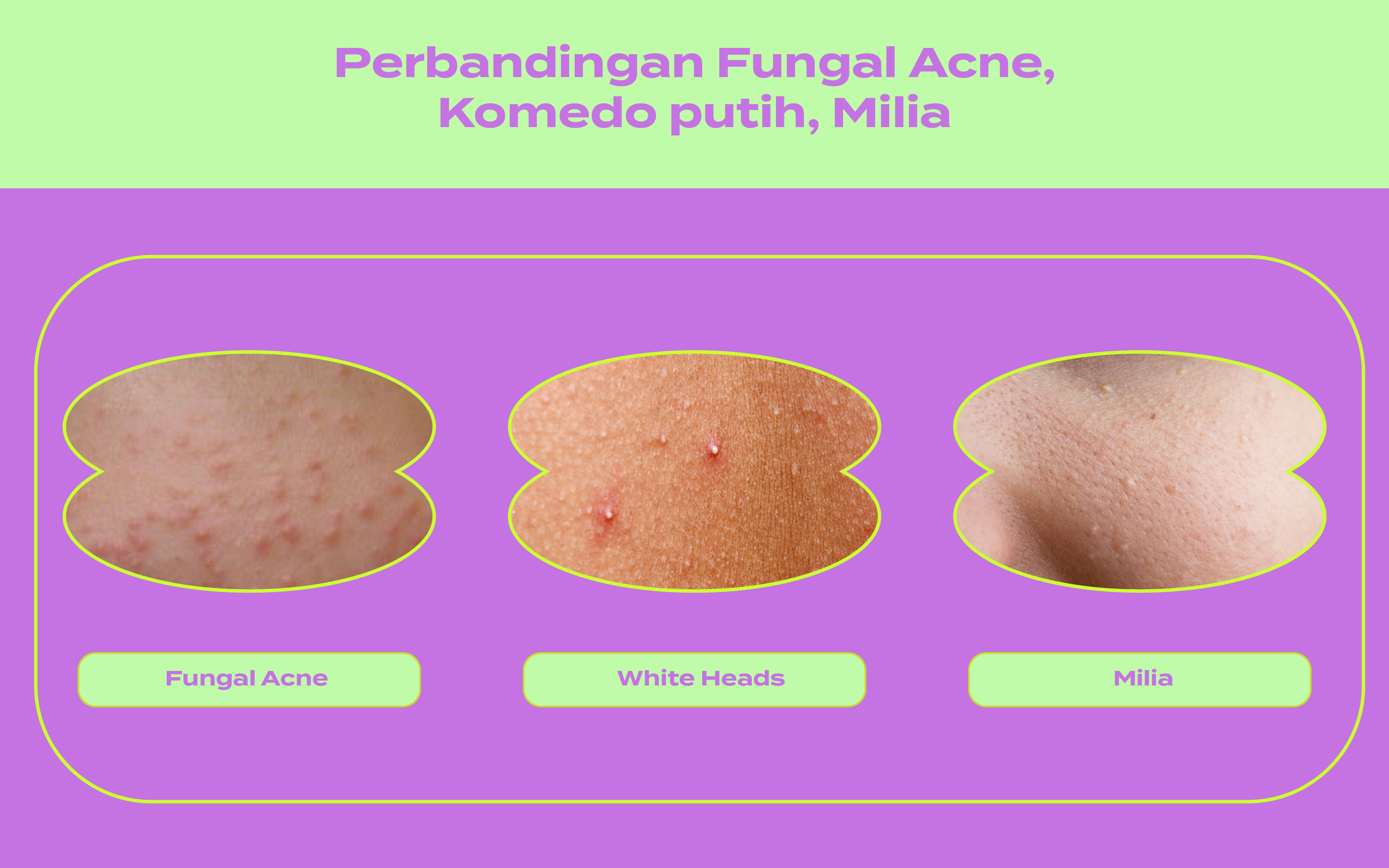 fungal acne