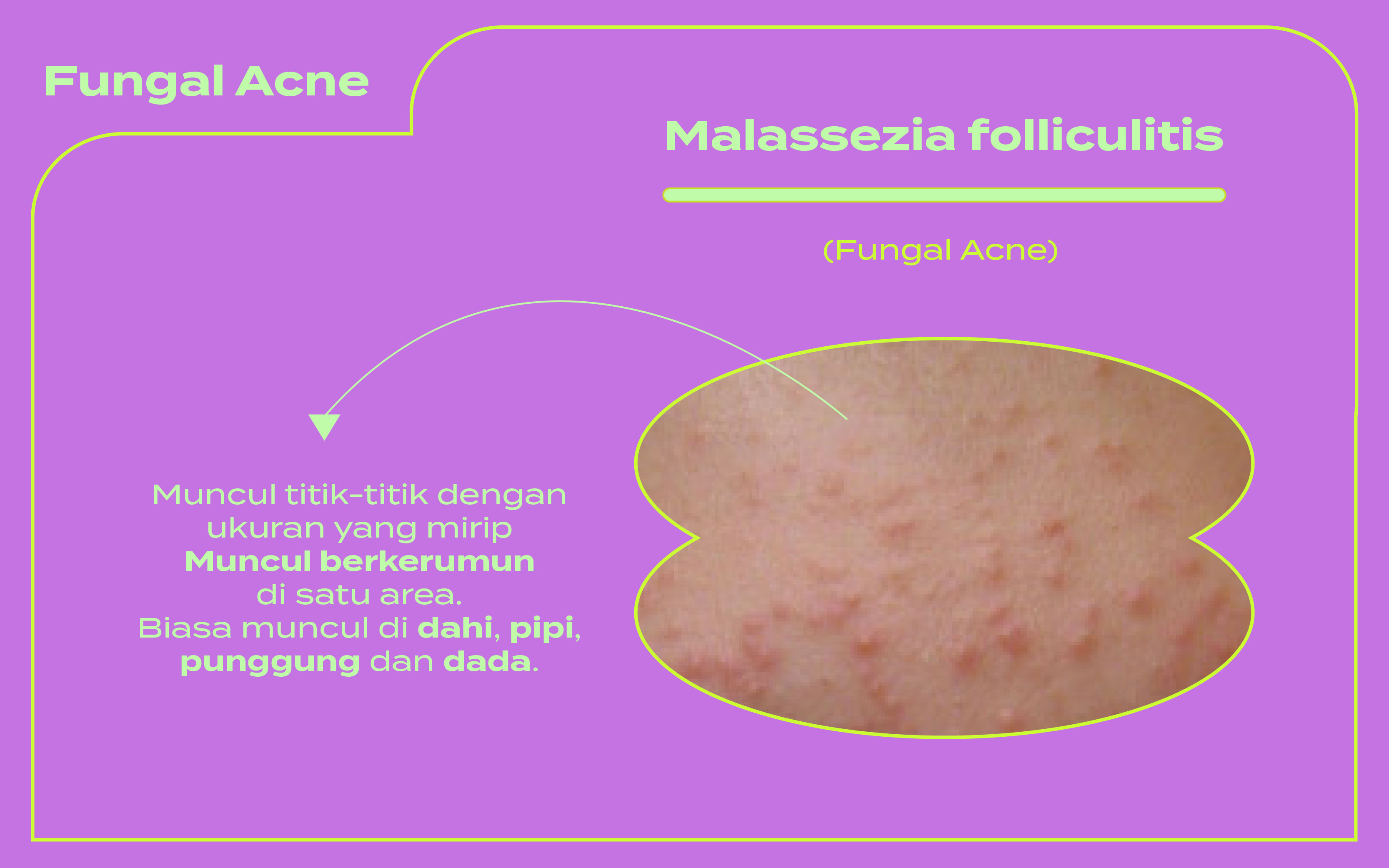 perbedaan komedo dan milia