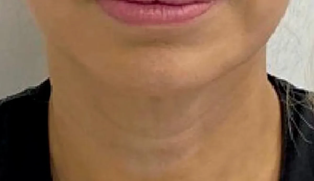 소프웨이브 · 턱선·목 · 1회 시술 3개월 후 1회 시술 3개월 후