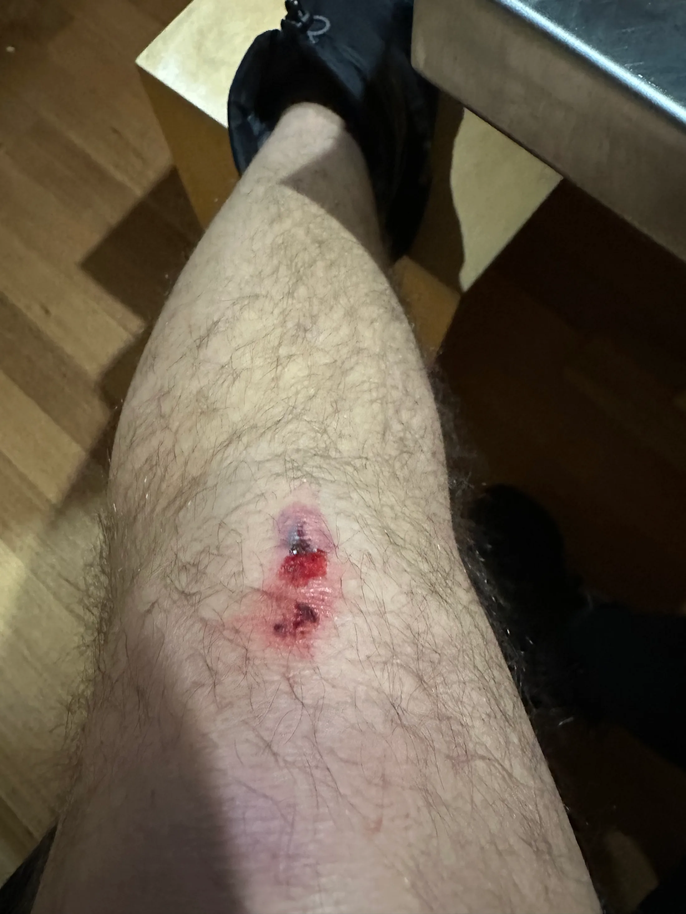 The bruised shin that made me consider pressing the SOS button on my first real day.