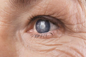 Treating Cataracts