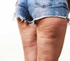 ANTI CELLULITIS