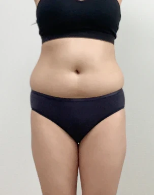 Abdominal liposuction before and after