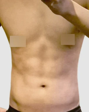 Male chest after surgery