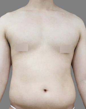 Male chest before surgery