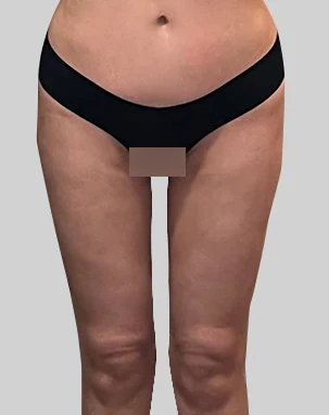 Thigh before revision