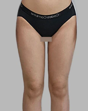 Thighs 4 months after surgery, front