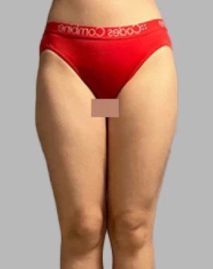 Thighs before surgery, front