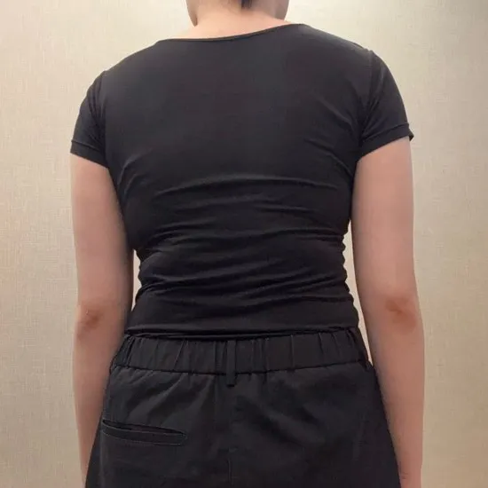 分享手臂與副乳抽脂心得～！ - 手臂抽脂 術後 6 - TheLINE 整形外科