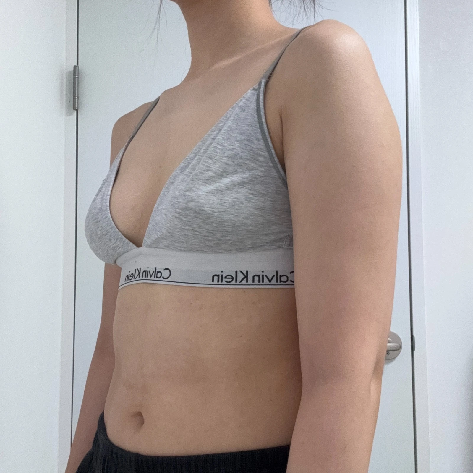手臂抽脂滿 6 個月啦！！！ - 手臂抽脂 術前 5 - TheLINE 整形外科