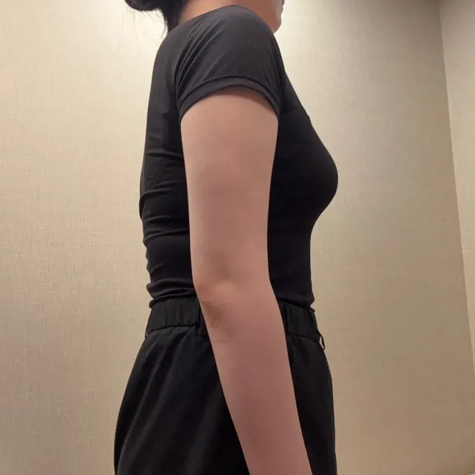 分享手臂與副乳抽脂心得～！ - 手臂抽脂 術後 5 - TheLINE 整形外科