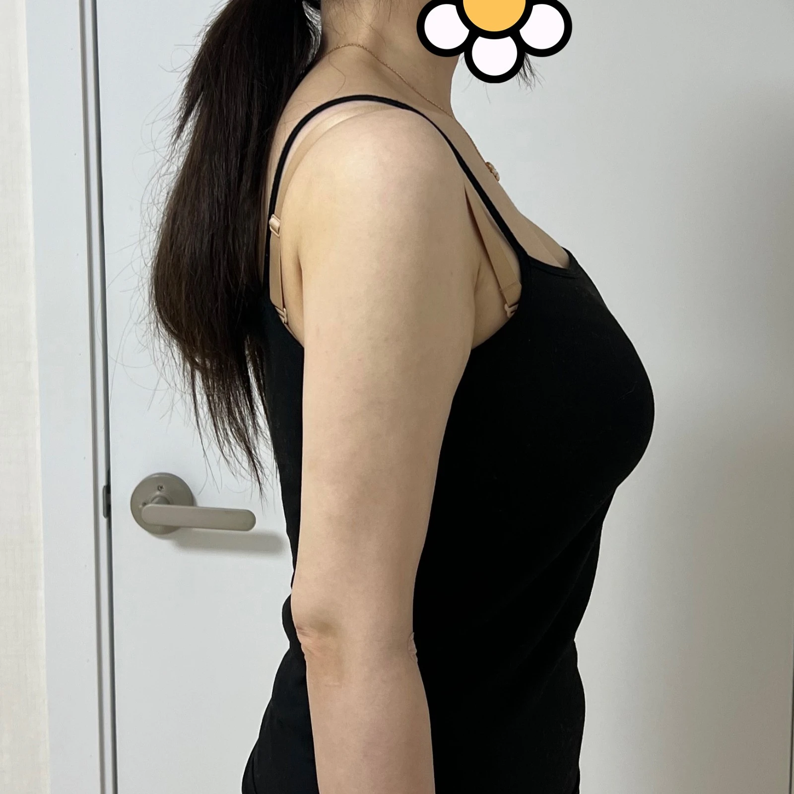 我做了手臂 360 度抽脂 - 手臂抽脂 術前 1 - TheLINE 整形外科
