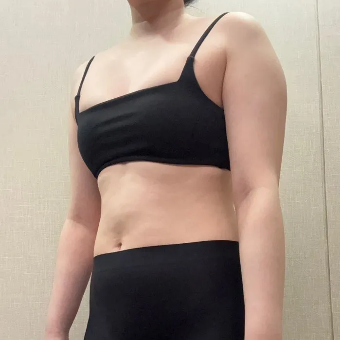 分享手臂與副乳抽脂心得～！ - 手臂抽脂 術前 3 - TheLINE 整形外科