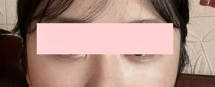 眼袋脂肪重置已經過了 6 個月！ - 拉皮・拉提 術後 1 - TheLINE 整形外科