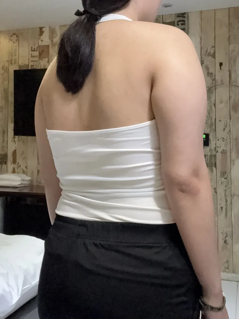 找鄭裕錫院長做手臂 360 度與副乳抽脂 - 手臂抽脂 術前 1 - TheLINE 整形外科