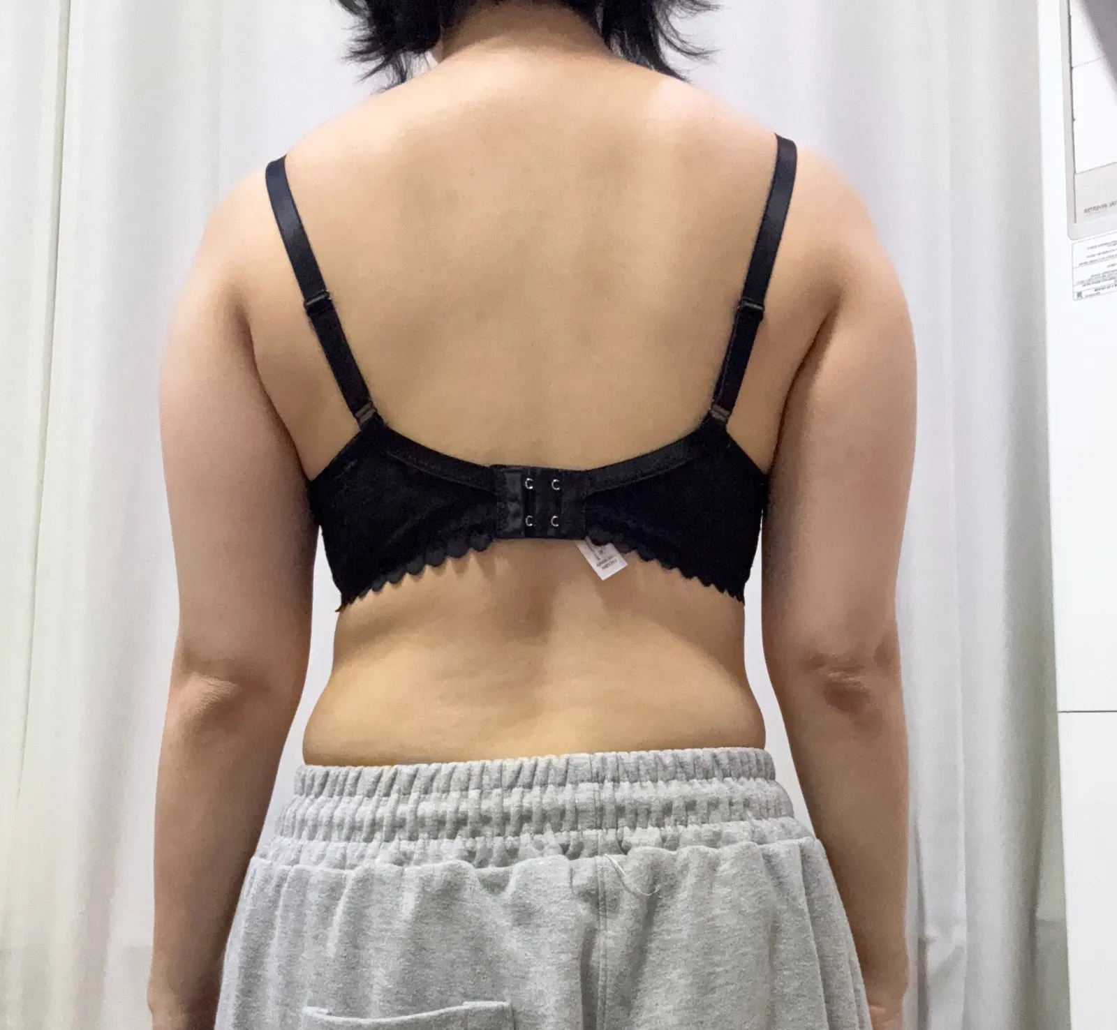 手臂手術後，已經滿 3 個月了 - 手臂抽脂 術前 2 - TheLINE 整形外科