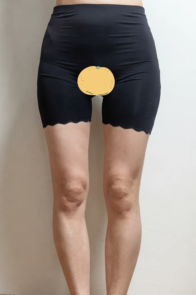 大腿抽脂滿 1 個月！ - 大腿抽脂（下半身） 術後 2 - TheLINE 整形外科