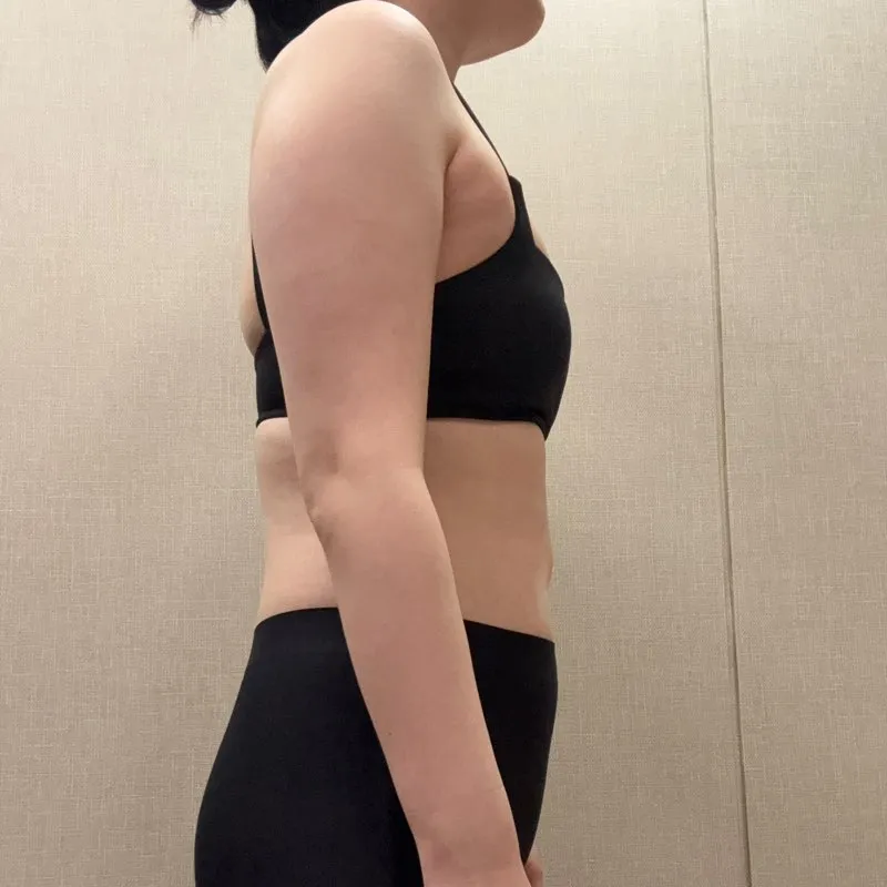 分享手臂與副乳抽脂心得～！ - 手臂抽脂 術前 1 - TheLINE 整形外科