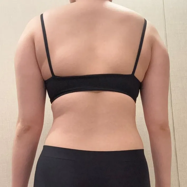 分享手臂與副乳抽脂心得～！ - 手臂抽脂 術前 2 - TheLINE 整形外科