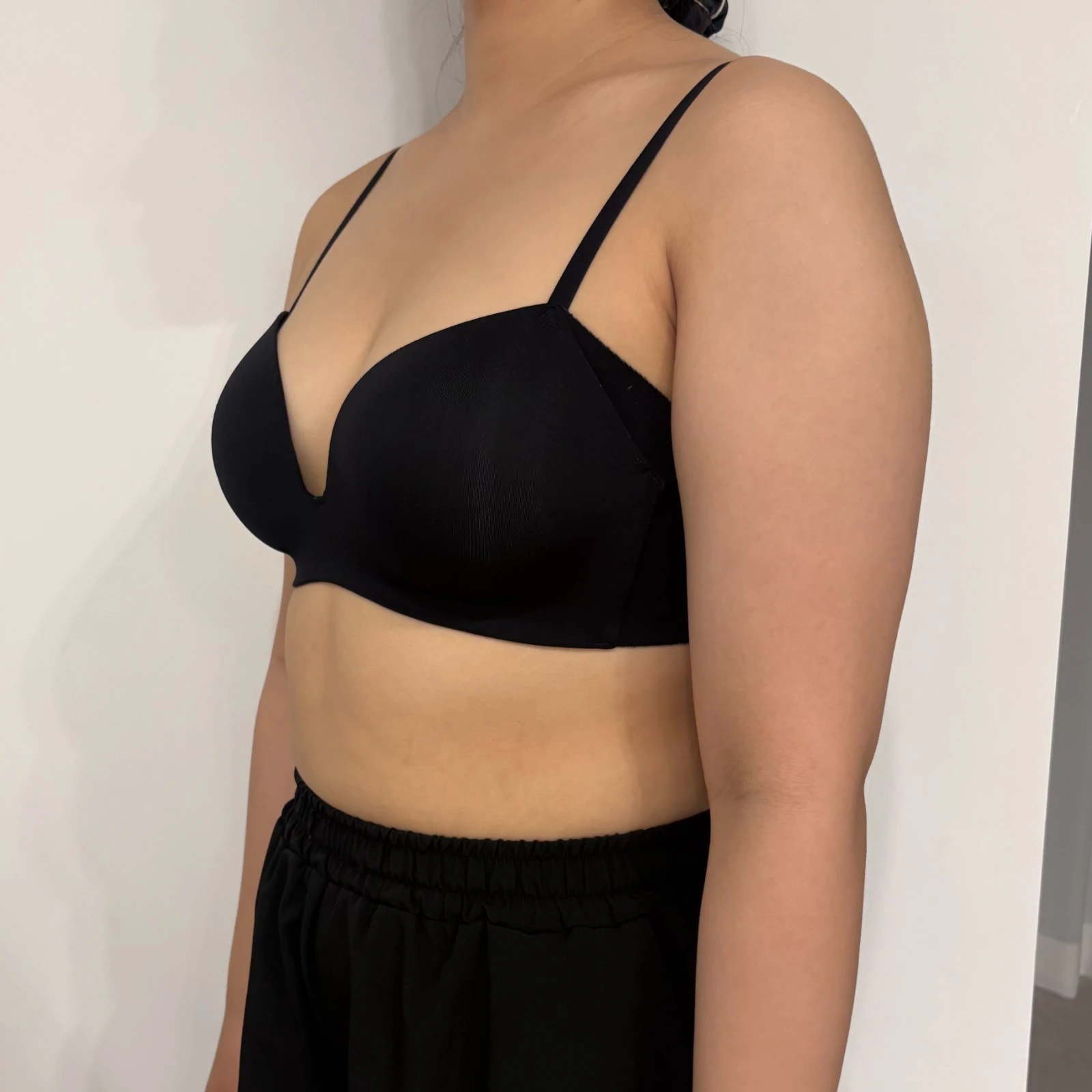 手臂、副乳、手臂根部抽脂，真的很滿意 - 手臂抽脂 術前 3 - TheLINE 整形外科
