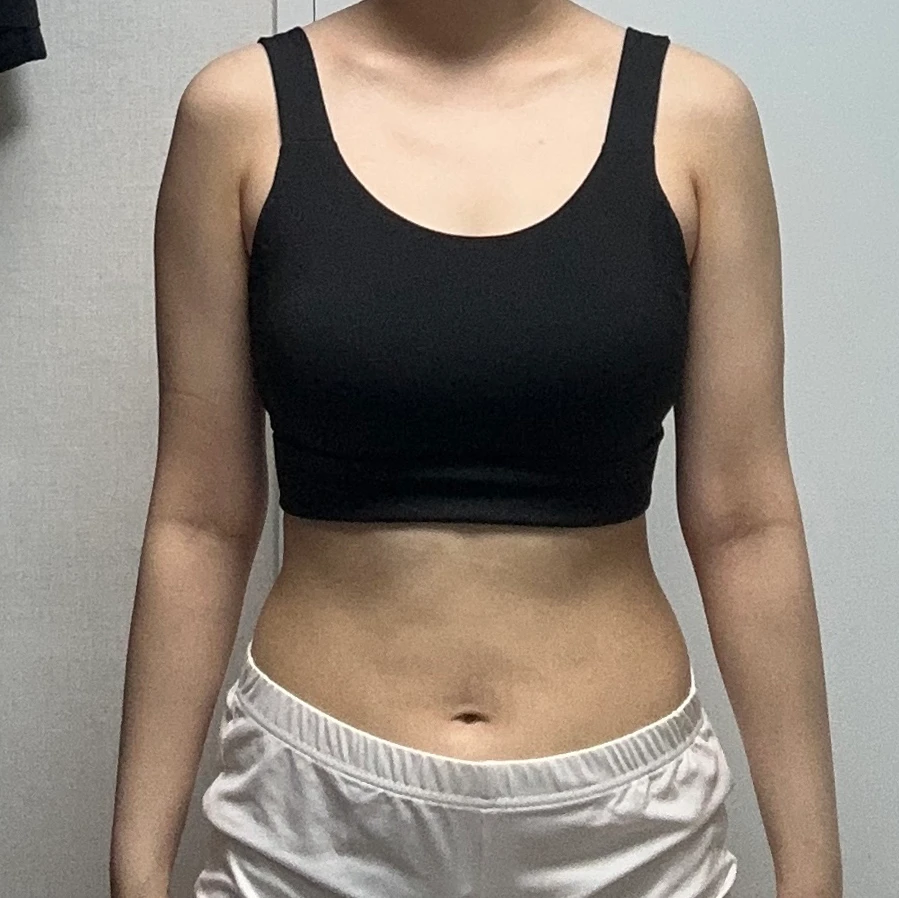 手臂抽脂第 3 個月 - 手臂抽脂 術前 1 - TheLINE 整形外科