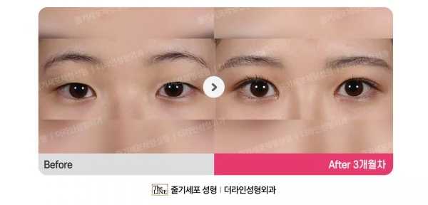Eyelid Surgery, Non-Incisional Method before-and-after photo, before surgery - TheLINE Plastic Surgery